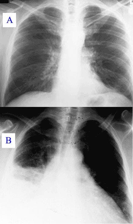 A chest X-ray showing increased opacity from fluid in the lungs